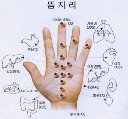 뜸 이미지